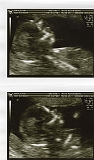 2nd Ultrasound 01